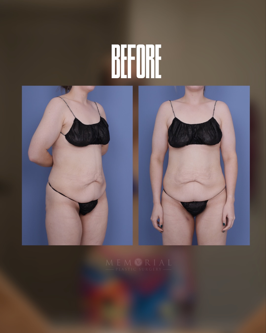 Bikini season came early! 😎
My beautiful patient did an amazing job and lost 100 lbs via diet and exercise. She came to me to complete her weight loss journey and here she is enjoying her new body at over 1 year post-op 🤩👏🏼
Procedure: Circumferential Body Lift + Lipo360 🔥
(Pre-Sx Wt: 161 lbs Ht: 5’8 BMI: 24.5)
#drvasilakis #beforeandafter #weightloss @memorialplasticsurgery